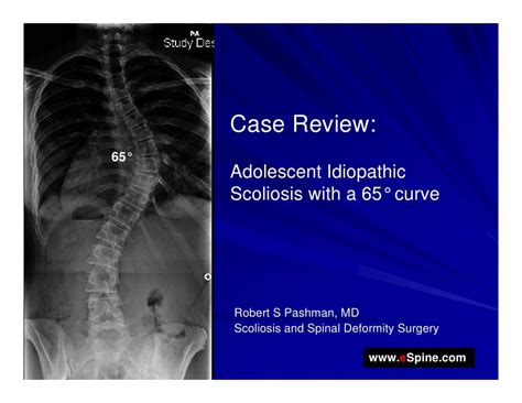 Case Review 5 14 Year Old Female With Adolescent Idiopathic Scolio