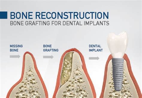 Bone Grafting Vancouver Burnaby BC Bone Graft Options For Implants