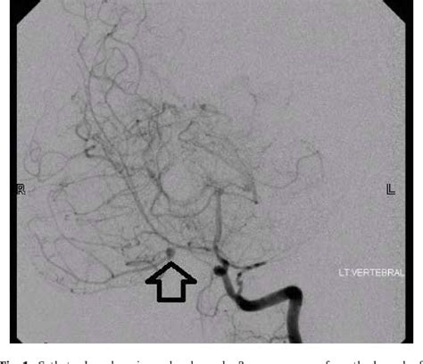 Figure 1 from Aneurysm in the anterior inferior cerebellar artery ...