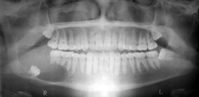 Contemporary Treatment of Ameloblastoma | Pocket Dentistry