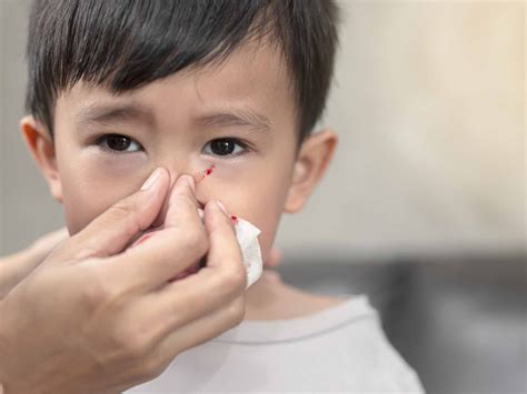 Come Fermare Il Sangue Dal Naso Ai Bambini Amico Pediatra