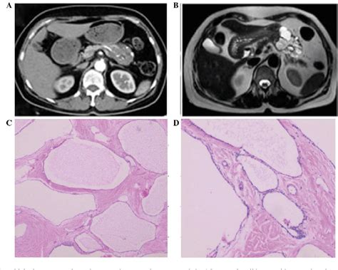 Figure From Serous Cystadenoma Of The Pancreas With Atypical Clinical