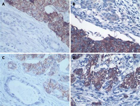 Immunohistochemistry For Chromogranin A Synaptophysin Cd And Ck Of