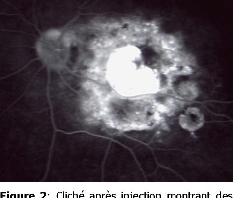 Figure From Tuberculome De Bouchut Dans La Tuberculose Multi Focale