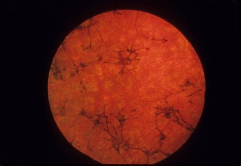 Usher Syndrome Type I | Hereditary Ocular Diseases