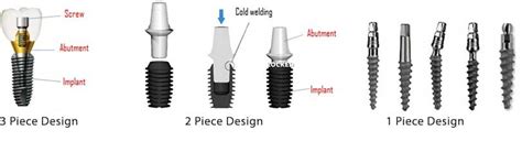 Components Of Dental Implants NYC Dental Implants Center