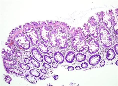 Qiaos Pathology Colon Hyperplastic Polyp Microscopic P… Flickr