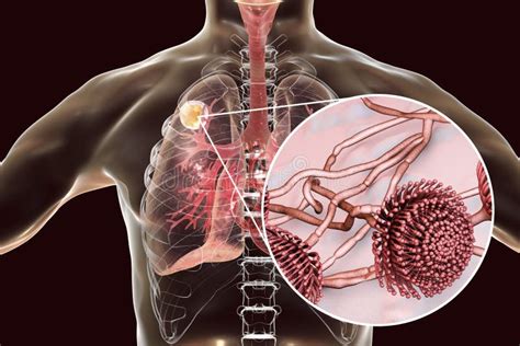 Ascesso Polmonare Infezione Microbica Del Polmone Che Provoca Necrosi