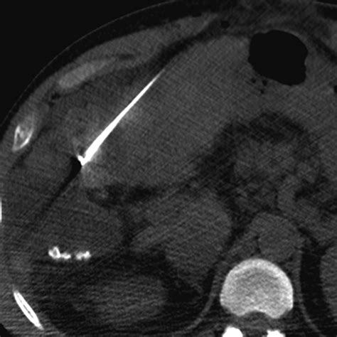 Imaging After Percutaneous Radiofrequency Ablation Of Hepatic Tumors