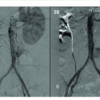 A B Contrast Enhanced Ct Showed Pseudoaneurysm Formation In The