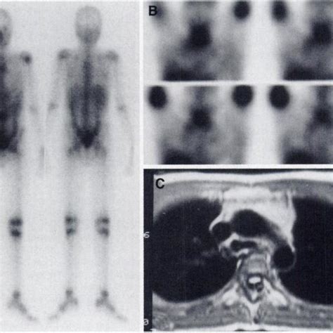 I 4 Total Body Image Anterior View Obtained 48 Hr After Injection Of