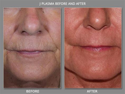 Renuvion With J Plasma Skin Resurfacing Non Surgical Facelift