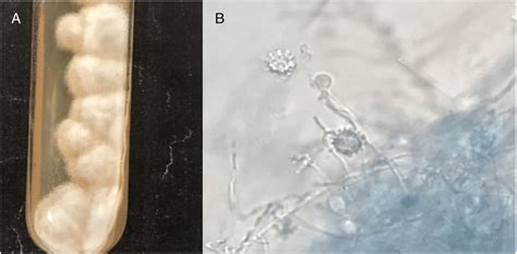 Histoplasma Capsulatum Culture On Sda At C After Days A And