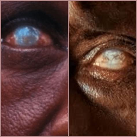 River Blindness Onchocerciasis Simpleeyedeas