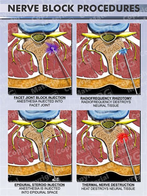 Nerve Block Procedures - Order