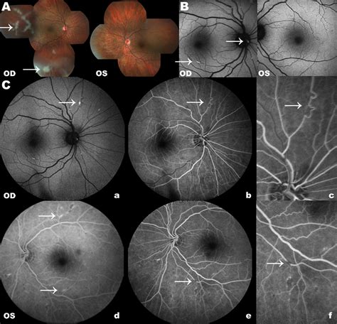 SciELO Brasil Retinal Amyloid Angiopathy Retinal Amyloid Angiopathy