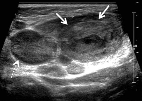 Subcutaneous Dermoid Cyst Ultrasound