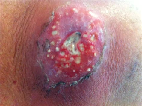 staph infection stages pictures  symptoms