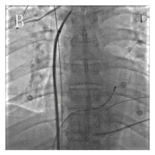 Transseptal Puncture With Fluoroscopy A At The Right Anterior