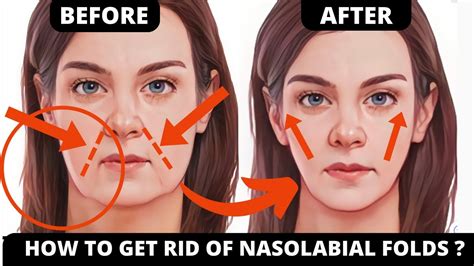 🛑 Smile Lines Saggy Jowls Facial Exercises Nasolabial Folds Laugh