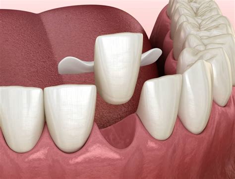 6 Benefits Of Using A Bonded Bridge To Replace A Missing Tooth Blog