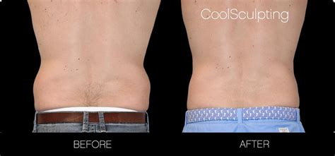 Before And After Photo Of A Patient Who Had CoolSculpting Zeltiq