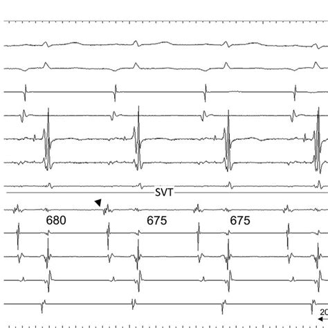 A 12 Lead Surface Electrocardiogram A At Rest B During Download Scientific Diagram