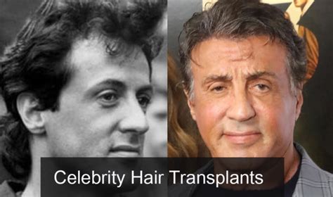 Top 20 Famous Celebrity Hair Transplants Before And After