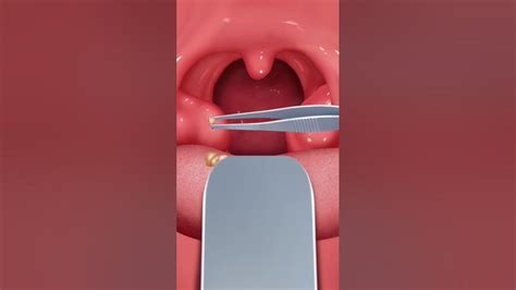 Tonsil Stone Removal Animation Satisfying Asmr Shorts Asmr