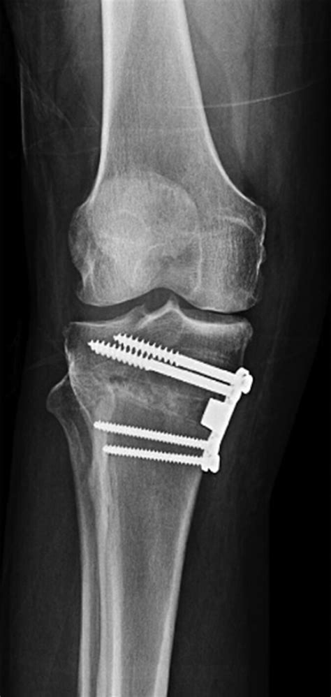 High Tibial Osteotomy An Update For Radiologists Ajr