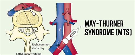 May-Thurner Syndrome: Symptoms and Treatments - Vascular Health