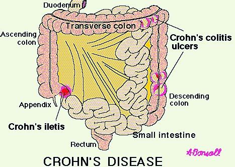 Chronic: Chronic Inflammation Of The Intestinal Tract