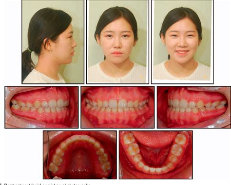 Figure 5 From Treatment Of Vertical Maxillary Excess Without Open Bite In A Skeletal Class Ii