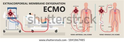 248 Ecmo Images Stock Photos And Vectors Shutterstock