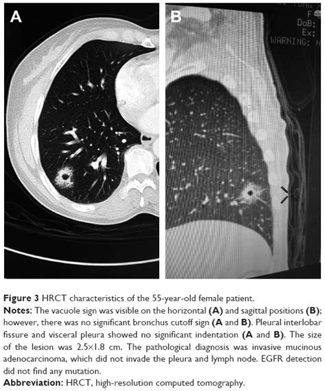 Correlation Between High Resolution Computed Tomography Lung Nodule Ch