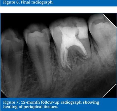 Figure 1 From Endodontic Treatment Of A Mandibular First Molar With Six