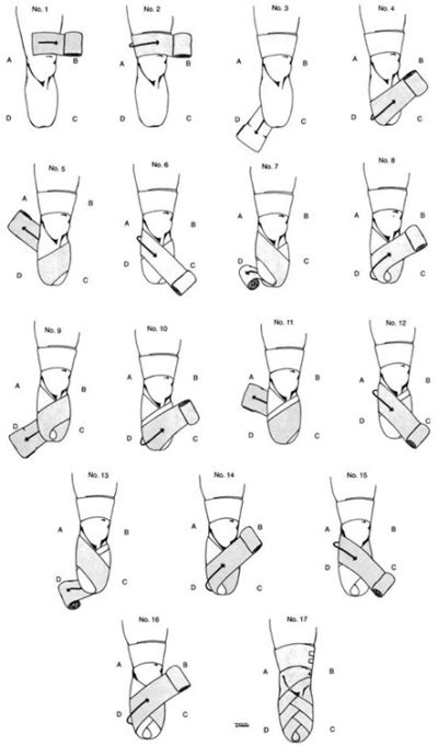 Pre Fitting Management Of The Amputee Physiopedia