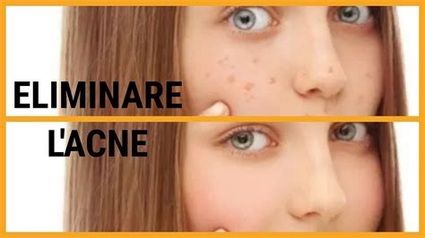 Come Eliminare L Acne Dal Viso Rimedio Naturale Youtube