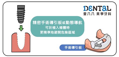 七大步驟認識植牙流程 高雄鳳山牙醫診所 壹八八美學牙醫