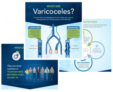 Varicocele Treatment IVC