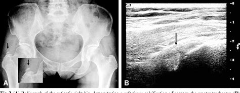 Figure 2 From Calcific Tendinitis Of The Gluteus Medius Tendon