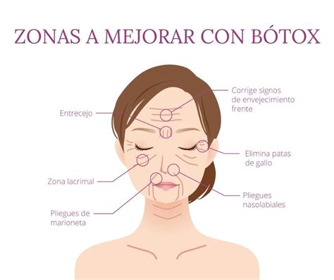 MITOS SOBRE EL BÓTOX Clínica Marta Suárez Medicina Estética Zaragoza