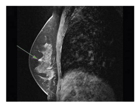 Mri Image Of Triple Negative Breast Cancer A Before Nac T W B