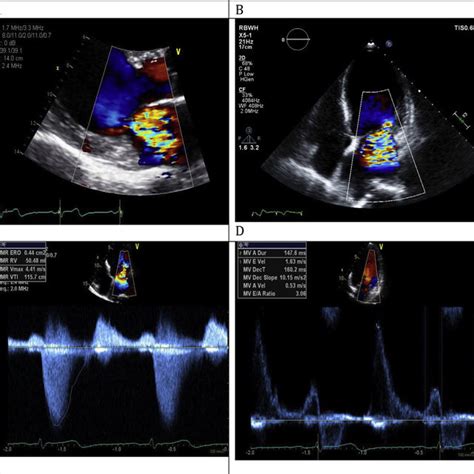 Transesophageal Echocardiography A Transesophageal Midesophageal