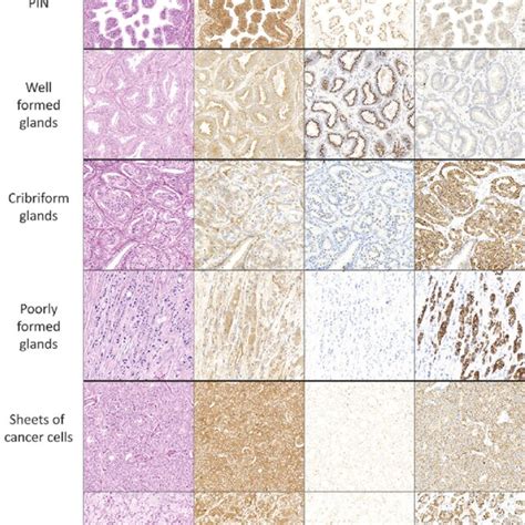 Prostate Cancer Morphologies Visualised By Hande Staining Or Biomarker Download Scientific