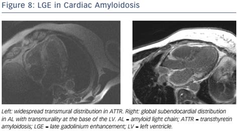 Figure 8 Lge In Cardiac Amyloidosis Radcliffe Cardiology