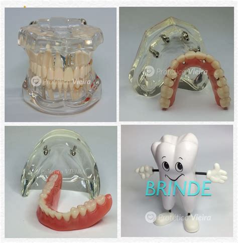 Manequim Modelo Odontológico Protocolo Overdenture Kit C 3 R 746