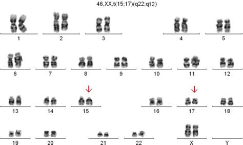 Atypical Features In A Patient With Acute Promyelocytic Leukaemia A