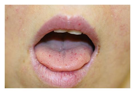 Typical Telangiectasia Of The Skin And Mucosa In A Patient With HHT