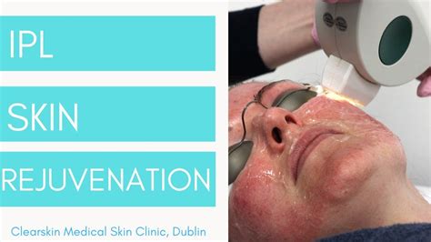 Ipl Skin Rejuvenation Youtube